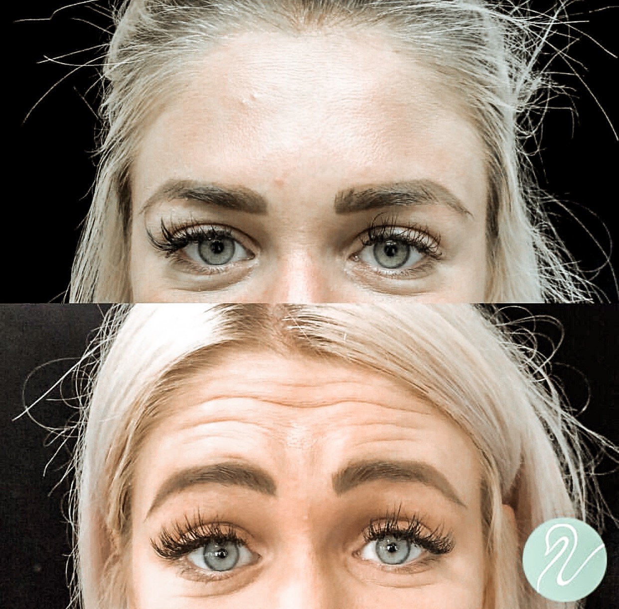 Lip fillers botox with the skin center md kelclight fashion and